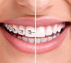 Her yasta uygun ortodontik tedavi yöntemleri